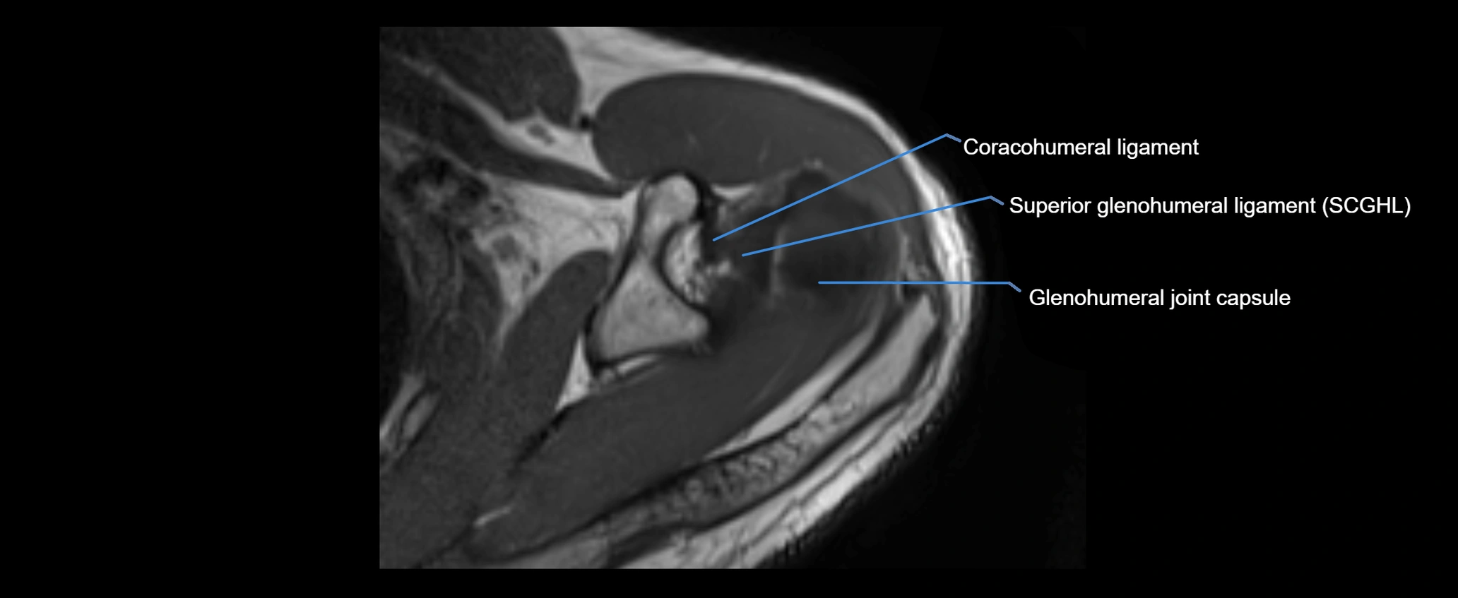 shoulder ligaments axial 3d 3t mri image-img-00005-00041.webp